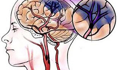 Mắc bệnh máu lên não chậm không được phép chủ quan?